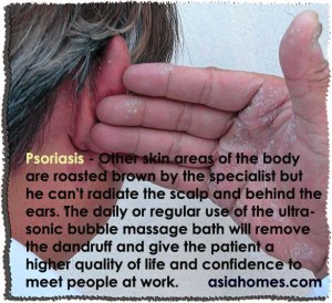 Psoriasis in a 50-year-old person.
