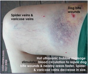Large bruised area 2 days after dog bite (old labrador cross dog)