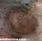 Lick wound on sternal skin lasting over 12 months. Silkie 4 years old, male 